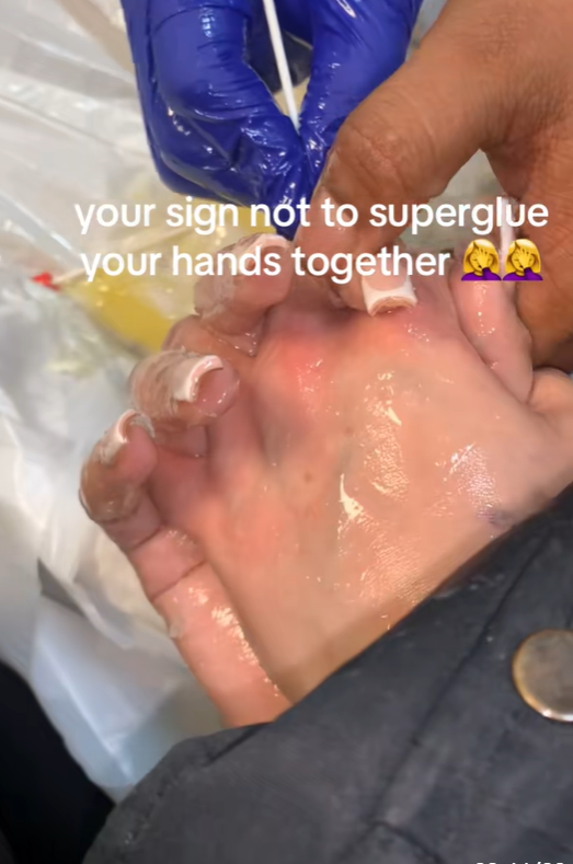 They Superglued Their Hands Together… Then Realized They’d Made a Huge Mistake