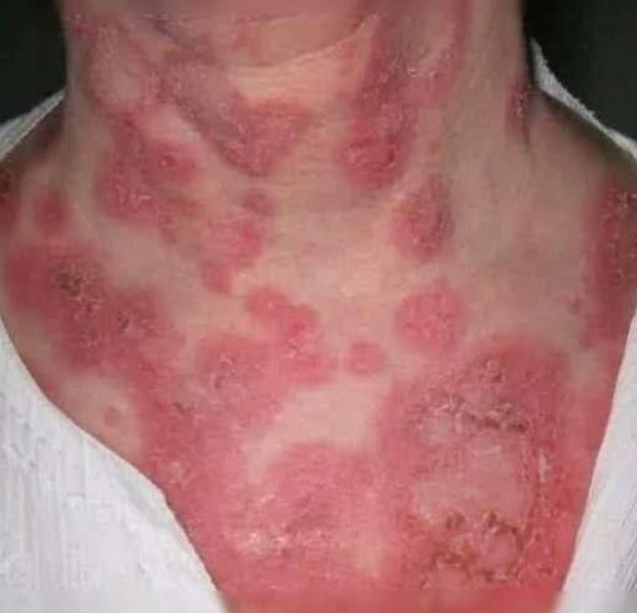 The Hidden Reasons You Keep Getting Pimples on Your Chin