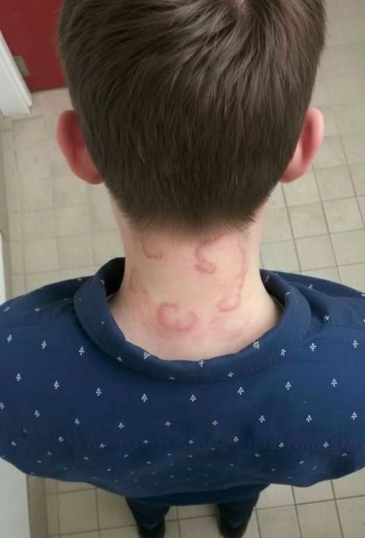How to identify and cure skin fungus or ringworm.