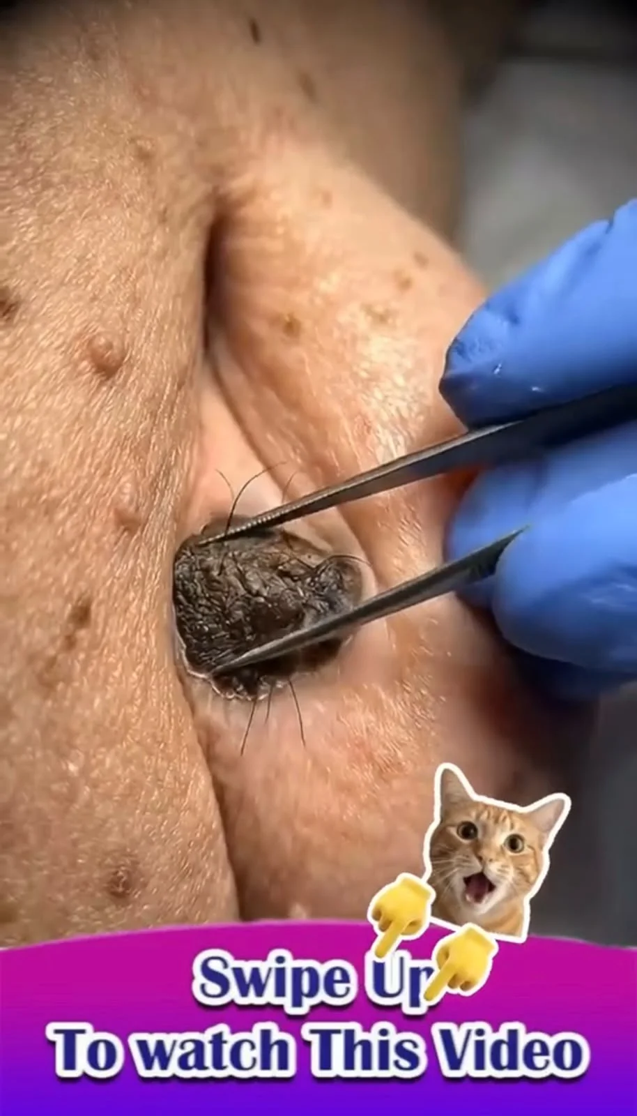 Giant Tick-Like Parasite Attached to the Ear: Why Safe Removal Matters